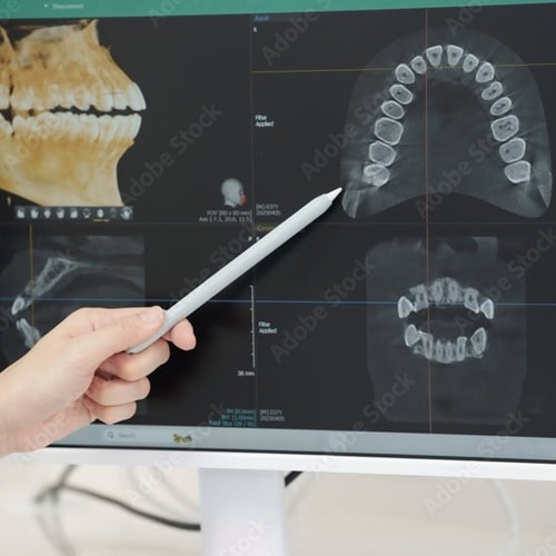 Weisheitszahn-Entfernung - Oralchirurgie Templin